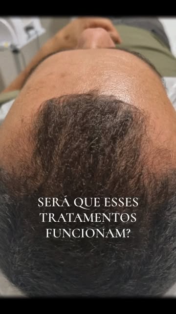 A alopecia androgenética causa o afinamento progressivo dos fios e a redução da densidade capilar. T