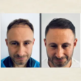 This gentleman  had  a 1500 graft FUE transplant and he is delighted  with his results 12 months pos
