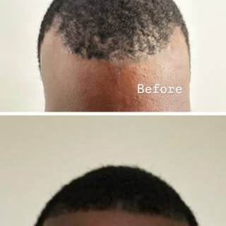 Even a smaller hair transplant case  can make a big difference  in reclaiming those lost edges.

At 