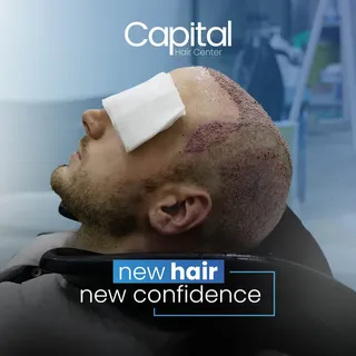 Unlocking a new level of confidence with a hair transplant in Turkey. Feel the transformative effect