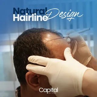 Transform your look with our natural hairline design using hair transplant. Say goodbye to receding 