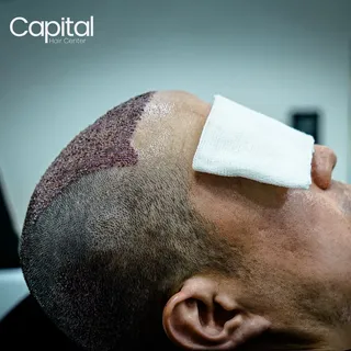 Let your hair restoration journey begin in Turkey.
Get a free consultation:
📲WhatsApp: +90 541 569 