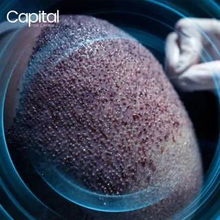 Reach maximum hair grafts with our cutting-edge hair transplant operation. Say goodbye to balding wo
