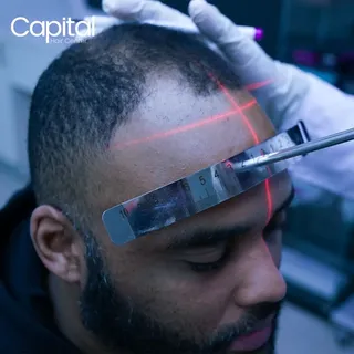 Join countless satisfied patients who have regained their confidence and a full head of hair with ha