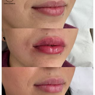 Una de las preguntas más frecuentes sobre el aumento de labios con ácido hialurónico es cuánto duran