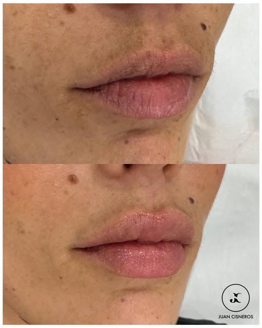 Cada vez más hombres recurren al ácido hialurónico para mejorar el aspecto de sus labios 👨‍⚕️

En e