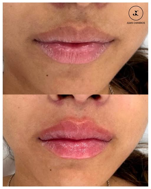 Después de un aumento de labios existen algunos cuidados sencillos que ayudan a optimizar el resulta