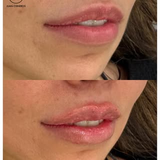 Muchas personas retrasan el tratamiento de labios por miedo al dolor 🤔

La realidad es que el aumen