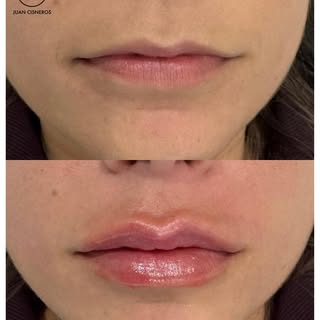 No todos los labios necesitan más volumen 💙

En muchos casos el tratamiento se enfoca en definir el