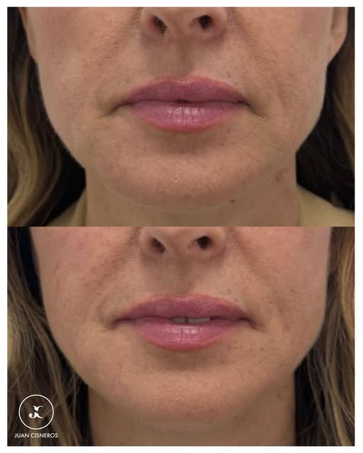 El Total Face combina diversas técnicas para crear un rostro rejuvenecido y equilibrado 🧖‍♀️

Cada 