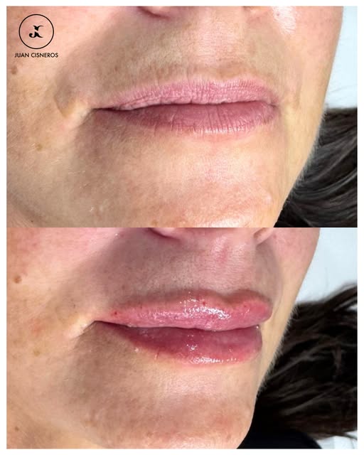 El aumento de labios no consiste únicamente en inyectar producto 💉

Detrás de cada tratamiento hay 