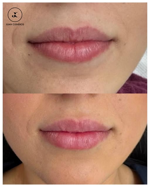 La hidratación de los labios es uno de los efectos más valorados por nuestros pacientes 💧

El ácido
