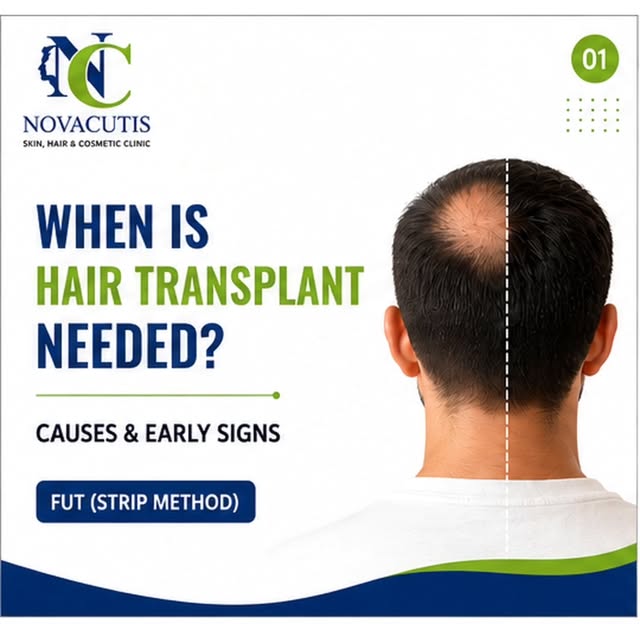 When is a Hair Transplant Needed? Know the Early Signs Before It's Too Late

Hair loss doesn't happe