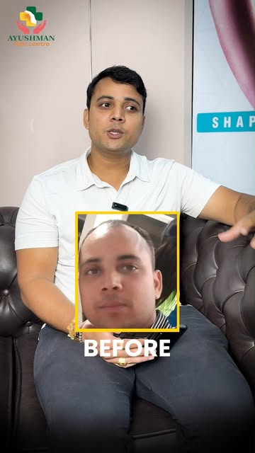 We are so proud of our patient, Dharam Raj, 

He shares his inspiring hair transplant journey! He ha