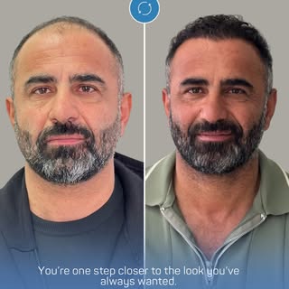 You’re not just getting your hair back, you’re getting your confidence back.

All surgical and inter