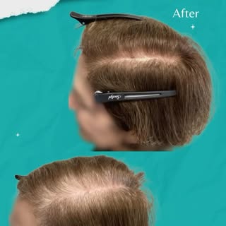 Unlock your hair’s natural potential with PRP! ✨ This cutting-edge treatment uses your own platelets