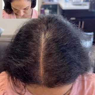 Hair thinning doesn’t have to define your confidence. 💗

Whether you’re experiencing thinning from 