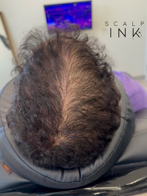 Why does scalp micropigmentation take multiple sessions? Because natural-looking density is built in