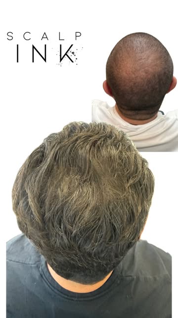 Two years healed—and his hair is completely grown back out. 👏

For this density procedure, our clie