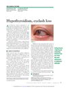 Hypothyroidism and Eyelash Loss in a 77-Year-Old Woman