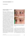 Successful use of bimatoprost in the treatment of alopecia of the eyelashes