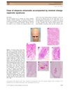 Case of alopecia universalis accompanied by minimal change nephrotic syndrome