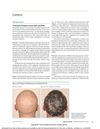 Treatment of Alopecia Areata With Tofacitinib