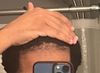 Thinning hairline. Will treatments work?