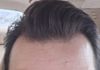 Am I thinning, or balding?