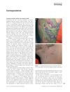 Lichenoid red tatoo reaction and alopecia areata