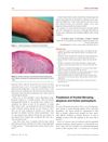 Treatment of Frontal Fibrosing Alopecia and Lichen Planopilaris