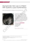Asymptomatic Hair Loss in a Patient With Systemic Lupus Erythematosus
