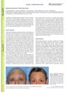 Alopecia Induced by Timolol Eye-drops