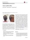 Diffuse Syphilitic Alopecia