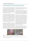 Laser Hair Removal in Alopecia Areata of the Scalp: A Novel Therapeutic Approach
