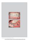 Vestibuloplasty with Retroauricular Skin Grafts for Dental Implant Rehabilitation in Vascularized Fibula Grafts: Two Case Reports