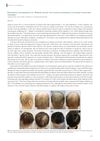 Successful Hair Regrowth in a Korean Patient with Alopecia Universalis Following Tofacitinib Treatment