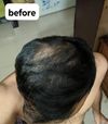 On Finasteride for 9 months and minoxidil for 5 months