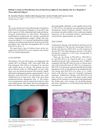 Bullous Lesions at Polyethylene Glycol Interferon-Alpha-2a Inoculation Site in a Hepatitis C Virus-Infected Subject