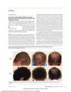 Association of Topical Minoxidil With Autosomal Recessive Woolly Hair/Hypotrichosis Caused by <i>LIPH</i> Pathogenic Variants