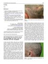 Use of beard hair as a donor source to camouflage the linear scars of follicular unit hair transplant