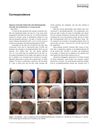 Alopecia universalis treated with simvastatin/ezetimibe, minoxidil, and prednisolone in a 6‐year‐old girl
