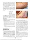 Psoriatic Skin Lesions Induced by Certolizumab Pegol