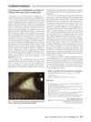 Corneal punctate epitheliopathy secondary to trichiasis following eyelash transplantation