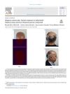 Alopecia Universalis: Partial Response to Tofacitinib