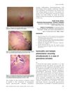 Isomorphic and isotopic phenomenon occurring simultaneously in a case of granuloma annulare