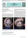 Concentric or Targetoid Regrowth in Alopecia Areata