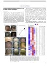 Extensive alopecia areata is reversed by IL-12/IL-23p40 cytokine antagonism