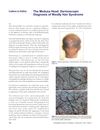 The medusa head: Dermoscopic diagnosis of woolly hair syndrome