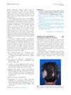 Alopecia areata and poliosis: A retrospective analysis of 258 cases